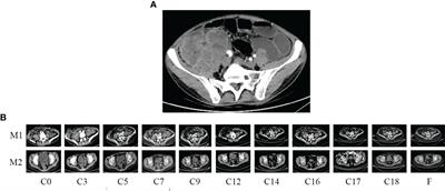 Complete remission in a pretreated, microsatellite-stable, KRAS-mutated colon cancer patient after treatment with sintilimab and bevacizumab and platinum-based chemotherapy: a case report and literature review